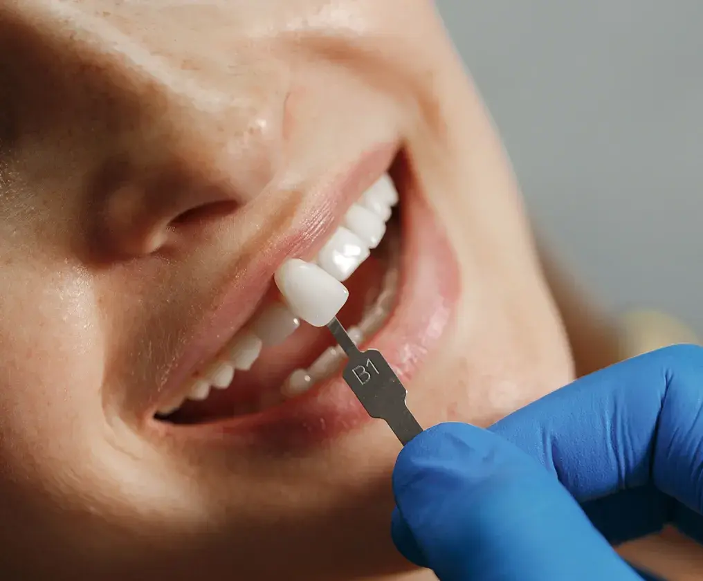 Close-up of a patient's smile as a dentist matches the shade of a replacement tooth against the front teeth